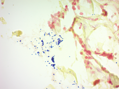 gram positive vs gram negative histology