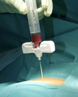 Busse Hospital Disposables, Inc. 630 J-Style Bone Marrow/ Aspiration Needle, 11G x 4\in., Sterile, 10/cs , case
