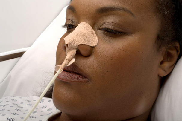 Dale Medical 160 One Size Fits Most Non-Sterile Nasogastric Disposable Tube Holder - 50/Box