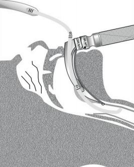 9-0212-70 Salter Labs Bougie Endotracheal Introducer, Adult, Coudé Tip, 10 Fr x 70 cm, Qty 10