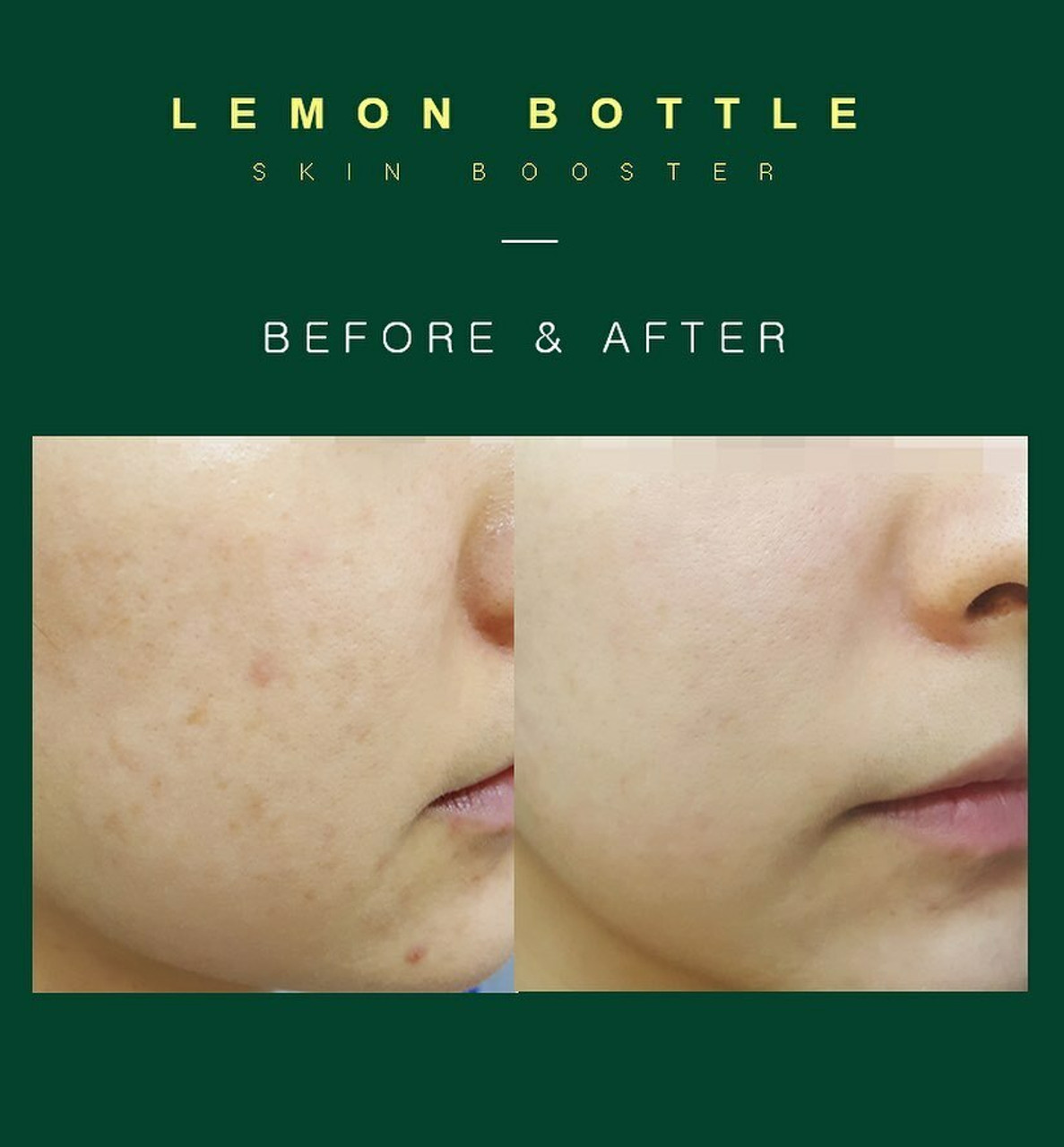 Lemon Bottle Skin Booster GetGlowing Skincare Lemon Bottle Skin Booster GetGlowing Skincare