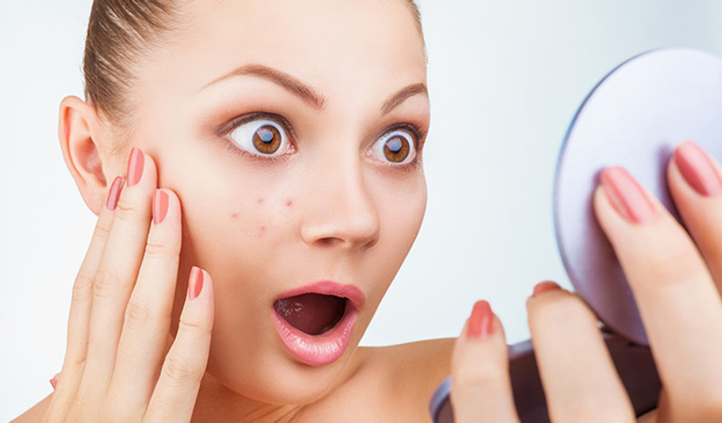 7 Beginner Tips for Preventing Acne Naturally 7 Beginner Tips for Preventing Acne Naturally