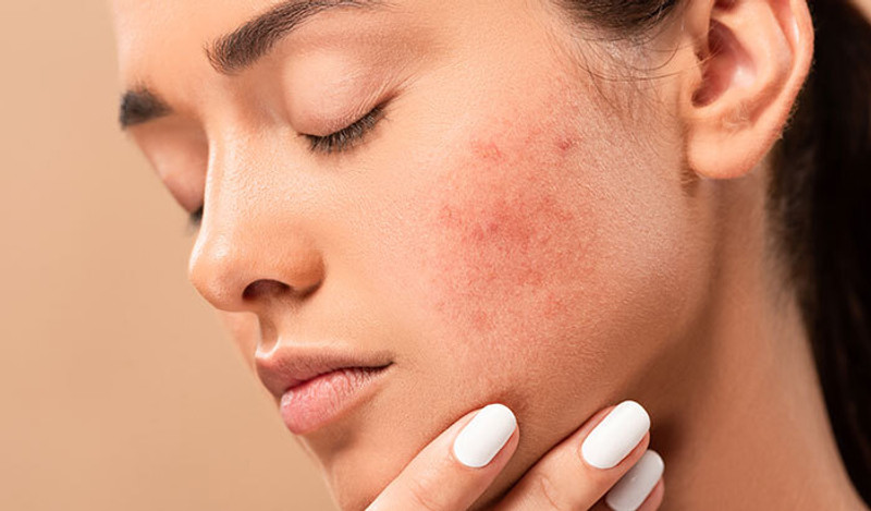 What Can I Do About My Acne Scars? Tips From the Experts