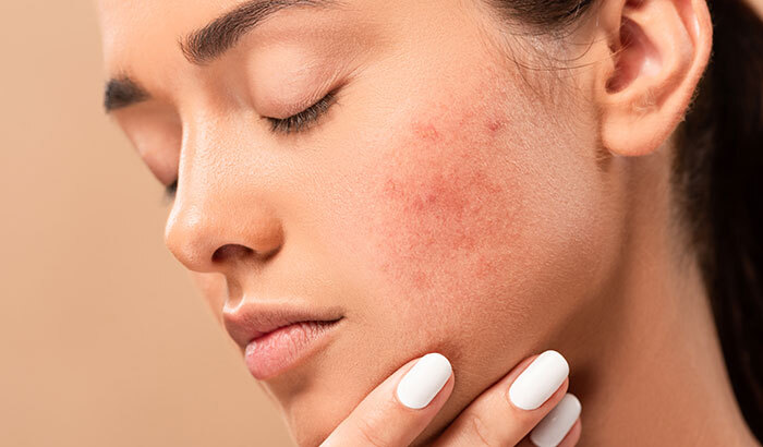 What Can I Do About My Acne Scars? Tips From the Experts