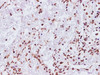 Immunohistochemistry of paraffin-embedded Human carcinoma of kidney using Lamin B1 Polyclonal Antibody at dilution of 1:100