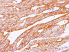 Immunohistochemistry of paraffin-embedded Human carcinoma of Colon  using POSTN Polyclonal Antibody at dilution of 1:100(400×)