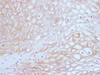 Immunohistochemistry of paraffin-embedded Human cervical cancer tissue using EGFR Polyclonal Antibody at dilution of 1:100