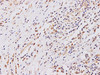 Immunohistochemistry of paraffin-embedded Human breast cancer using PTEN Polyclonal Antibody at dilution of 1:100