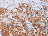 Immunohistochemistry of paraffin-embedded Human liver cancer  using GSTM1 Polyclonal Antibody at dilution of 1:100
