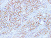 Immunohistochemistry of paraffin-embedded Human ovarian cancer using CD59 Polyclonal Antibody at dilution of 1:100
