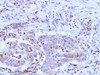 Immunohistochemistry of paraffin-embedded Human stomach cancer using NFκB-p65 Polyclonal Antibody at dilution of 1:100
