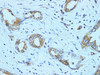 Immunohistochemistry of paraffin-embedded Human pancreatic cancer using NF2 Polyclonal Antibody at dilution of 1:100(100×)