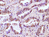 Immunohistochemistry of paraffin-embedded Human lung cancer using RBM3 Polyclonal Antibody at dilution of 1:100