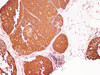 Immunohistochemistry of paraffin-embedded Human breast cancer using S100A9 Polyclonl Antibody at dilution of 1:200.