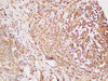 Immunohistochemistry of paraffin-embedded Human breast cancer using beta actin Polyclonal Antibody at dilution of 1:200