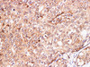 Immunohistochemistry of paraffin-embedded Human breast cancer  using S100A11 Polyclonal Antibody at dilution of 1:200