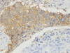 Immunohistochemistry of paraffin-embedded Human lung cancer using CD109 Ployclonal Antibody at dilution of 1:100.