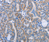 Immunohistochemistry of paraffin-embedded Human thyroid cancer tissue using FN1 Polyclonal Antibody at dilution 1:50