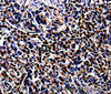 Immunohistochemistry of paraffin-embedded Human stomach cancer tissue using S100A4 Polyclonal Antibody at dilution 1:100