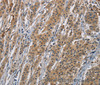 Immunohistochemistry of paraffin-embedded Human gastic cancer using RAGE Polyclonal Antibody at dilution of 1:70