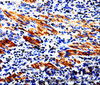 Immunohistochemistry of paraffin-embedded Human stomach cancer tissue using ACSBG2 Polyclonal Antibody at dilution 1:60