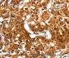 Immunohistochemistry of paraffin-embedded Human lung cancer using ADAP1 Polyclonal Antibody at dilution of 1:60