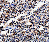 Immunohistochemistry of paraffin-embedded Human colon cancer tissue using ALOX5 Polyclonal Antibody at dilution 1:50