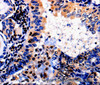Immunohistochemistry of paraffin-embedded Human thyroid cancer tissue using ALOX5 Polyclonal Antibody at dilution 1:50