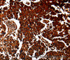 Immunohistochemistry of paraffin-embedded Human lung cancer tissue using ANXA7 Polyclonal Antibody at dilution 1:40