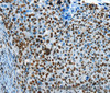 Immunohistochemistry of paraffin-embedded Human cervical cancer tissue using CREB1 Polyclonal Antibody at dilution 1:30