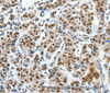 Immunohistochemistry of paraffin-embedded Human breast cancer tissue using CREB1 Polyclonal Antibody at dilution 1:30