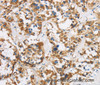 Immunohistochemistry of paraffin-embedded Human thyroid cancer using COX6B1 Polyclonal Antibody at dilution of 1:50