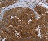 Immunohistochemistry of paraffin-embedded Human ovarian cancer using SNCG Polyclonal Antibody at dilution of 1:60