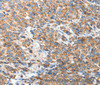 Immunohistochemistry of paraffin-embedded Human esophagus cancer using BAK1 Polyclonal Antibody at dilution of 1:50