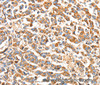 Immunohistochemistry of paraffin-embedded Human breast cancer using BAK1 Polyclonal Antibody at dilution of 1:50