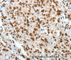 Immunohistochemistry of paraffin-embedded Human esophagus cancer using BNIP1 Polyclonal Antibody at dilution of 1:60