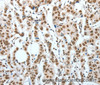 Immunohistochemistry of paraffin-embedded Human breast cancer using BNIP1 Polyclonal Antibody at dilution of 1:60