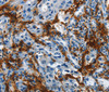 Immunohistochemistry of paraffin-embedded Human lung cancer tissue using IL20RA Polyclonal Antibody at dilution 1:35