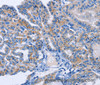 Immunohistochemistry of paraffin-embedded Human thyroid cancer using AMACR Polyclonal Antibody at dilution of 1:30