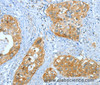 Immunohistochemistry of paraffin-embedded Human cervical cancer using ANXA3 Polyclonal Antibody at dilution of 1:35