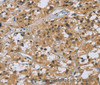 Immunohistochemistry of paraffin-embedded Human thyroid cancer tissue using CK-5 Polyclonal Antibody at dilution 1:30