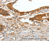 Immunohistochemistry of paraffin-embedded Human colon cancer tissue using COL1A2 Polyclonal Antibody at dilution 1:70