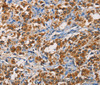 Immunohistochemistry of paraffin-embedded Human thyroid cancer tissue using APLNR Polyclonal Antibody at dilution 1:50