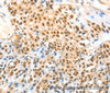 Immunohistochemistry of paraffin-embedded Human esophagus cancer using APPL1 Polyclonal Antibody at dilution of 1:70