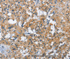 Immunohistochemistry of paraffin-embedded Human thyroid cancer tissue using CREB2 Polyclonal Antibody at dilution 1:40