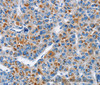 Immunohistochemistry of paraffin-embedded Human liver cancer tissue using CREB2 Polyclonal Antibody at dilution 1:40