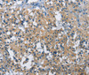 Immunohistochemistry of paraffin-embedded Human thyroid cancer tissue using BMPR1B Polyclonal Antibody at dilution 1:30