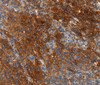 Immunohistochemistry of paraffin-embedded Human liver cancer tissue using CA9 Polyclonal Antibody at dilution 1:50