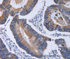 Immunohistochemistry of paraffin-embedded Human colon cancer using CA4 Polyclonal Antibody at dilution of 1:30
