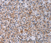 Immunohistochemistry of paraffin-embedded Human prostate cancer using CA4 Polyclonal Antibody at dilution of 1:30